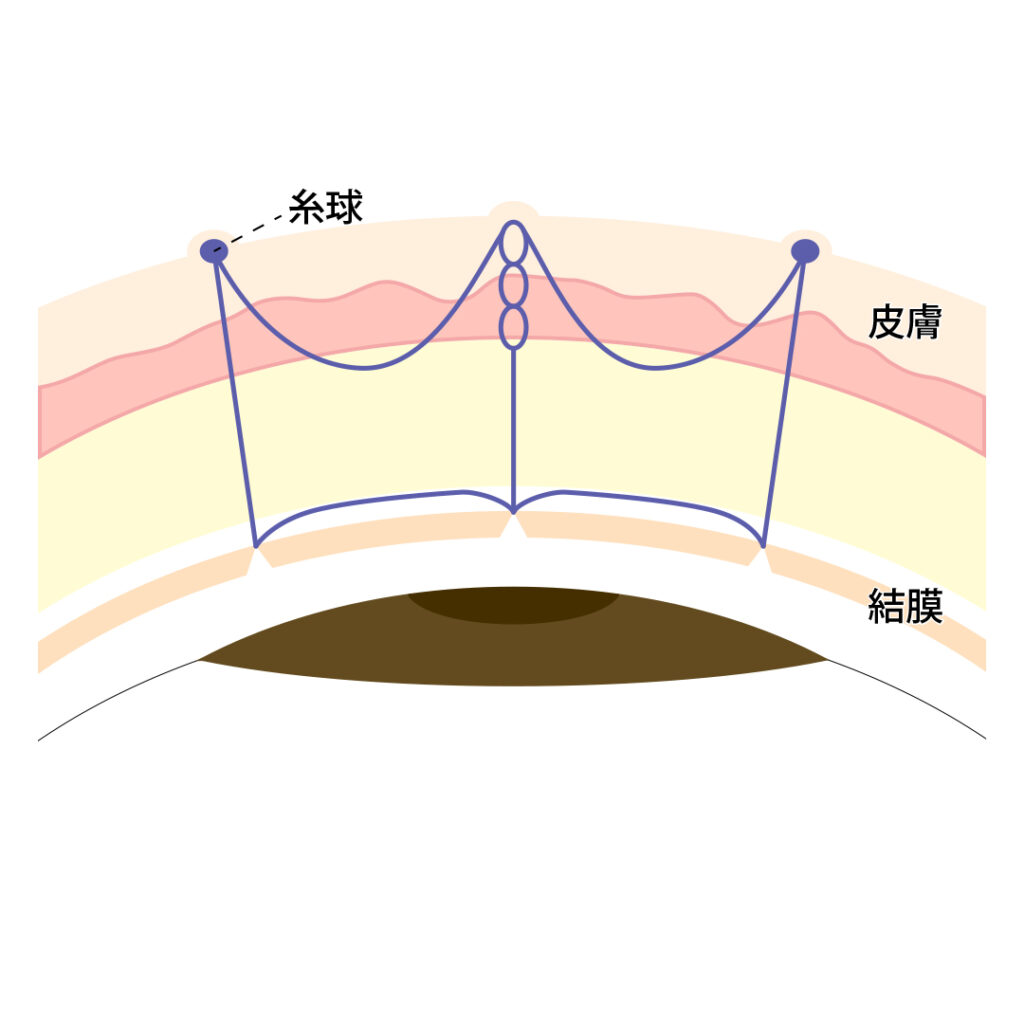 3点どめスクエア法