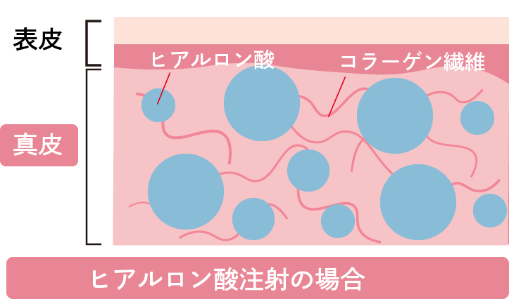 ボライトXCとは